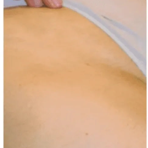 Laser hair Removal - Brazilian