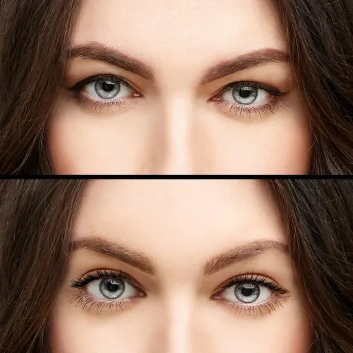 Nonsurgical Blepharoplasty (Eye Bags)