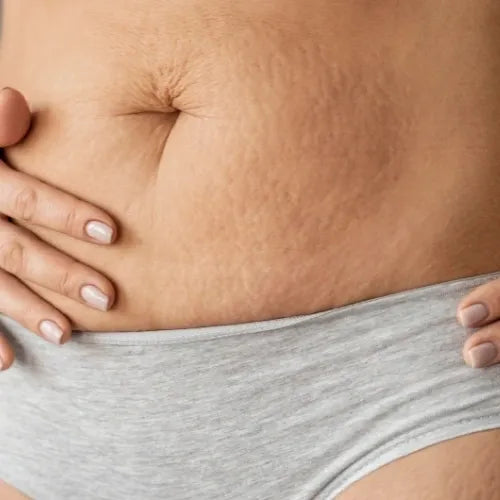 Stretch marks reduction