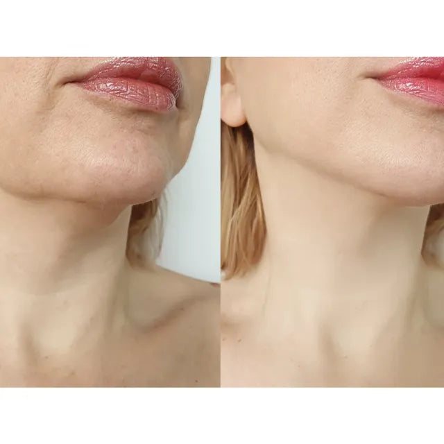 Face / Chin & Jawline contouring