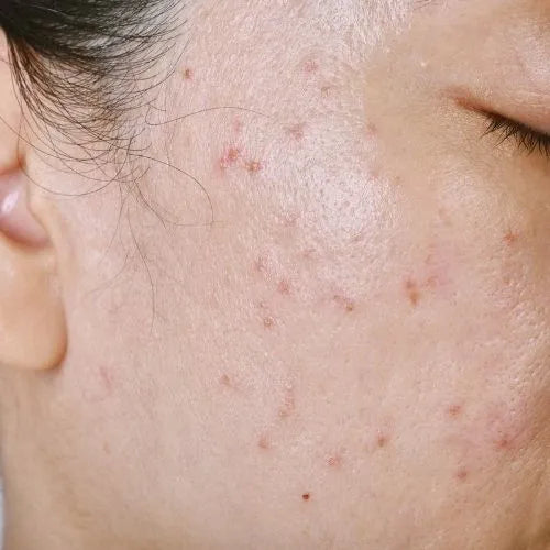 Acne Treatment