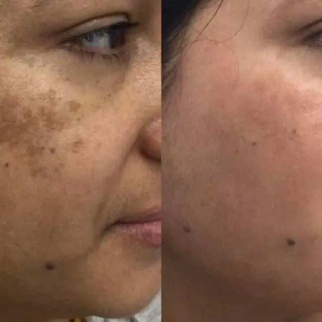Skin Needling